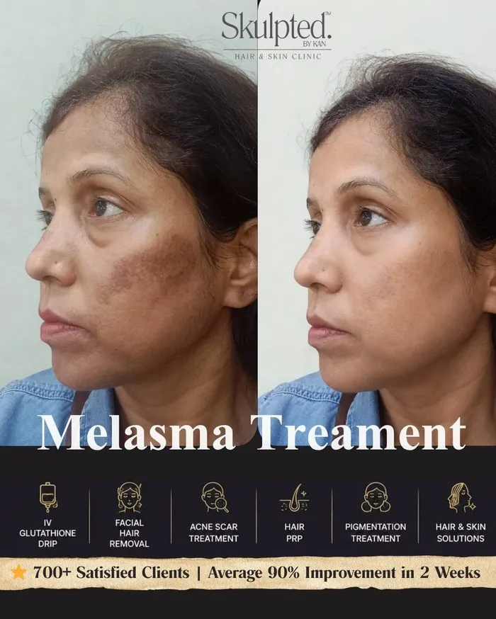 Melasma Treatment