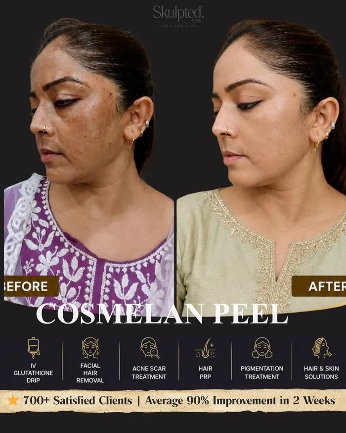Cosmelan Peel