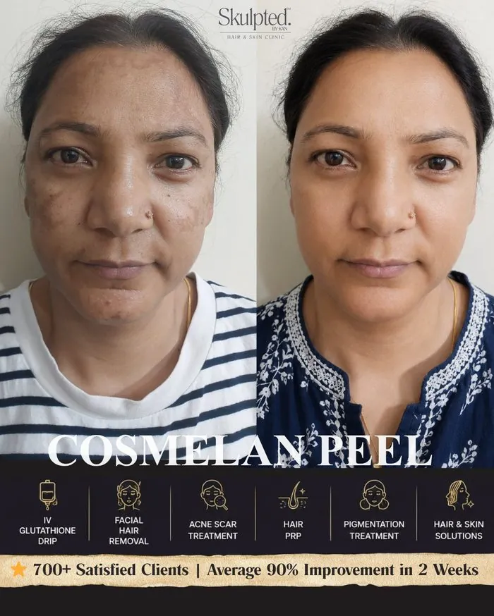 Cosmelan Peel