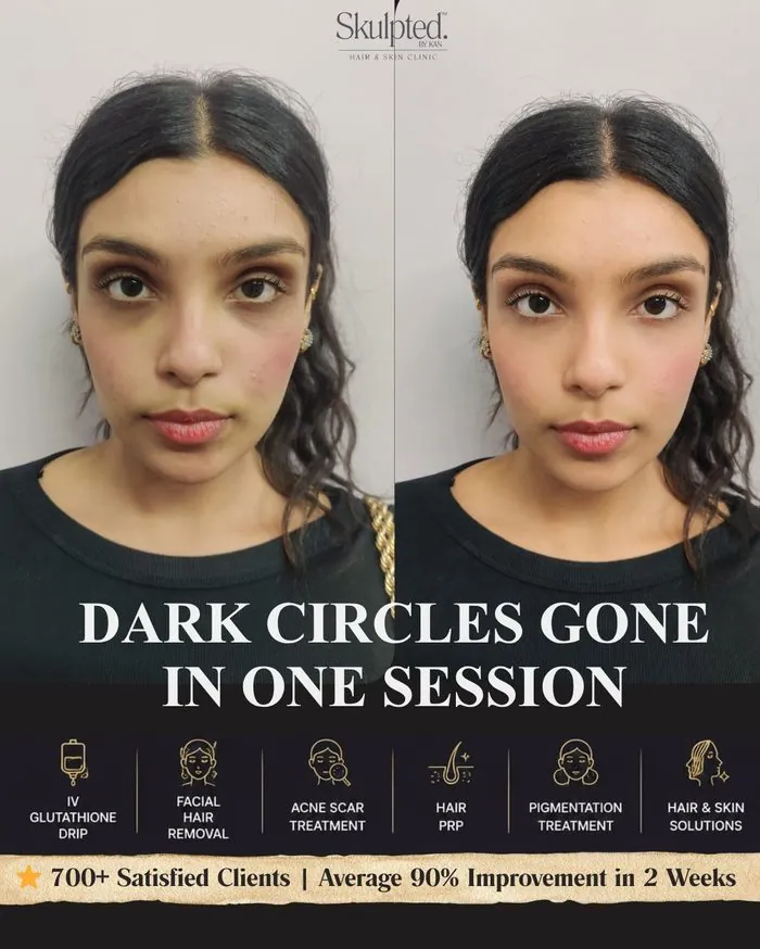 Dark Circles Treatment