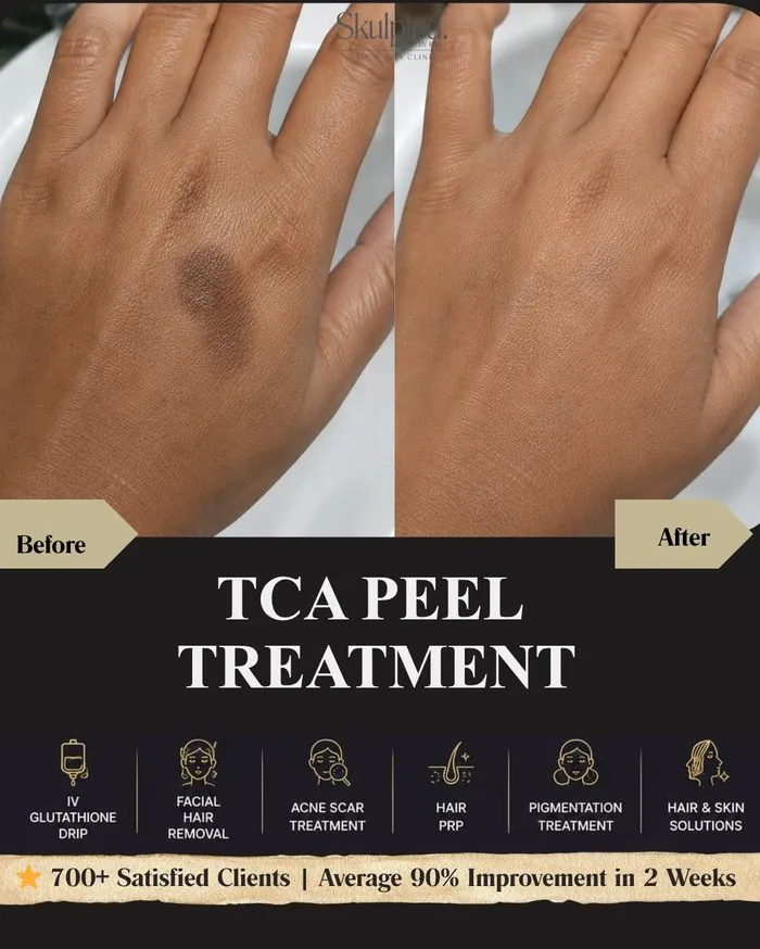 TCA Peel — Pigmentation