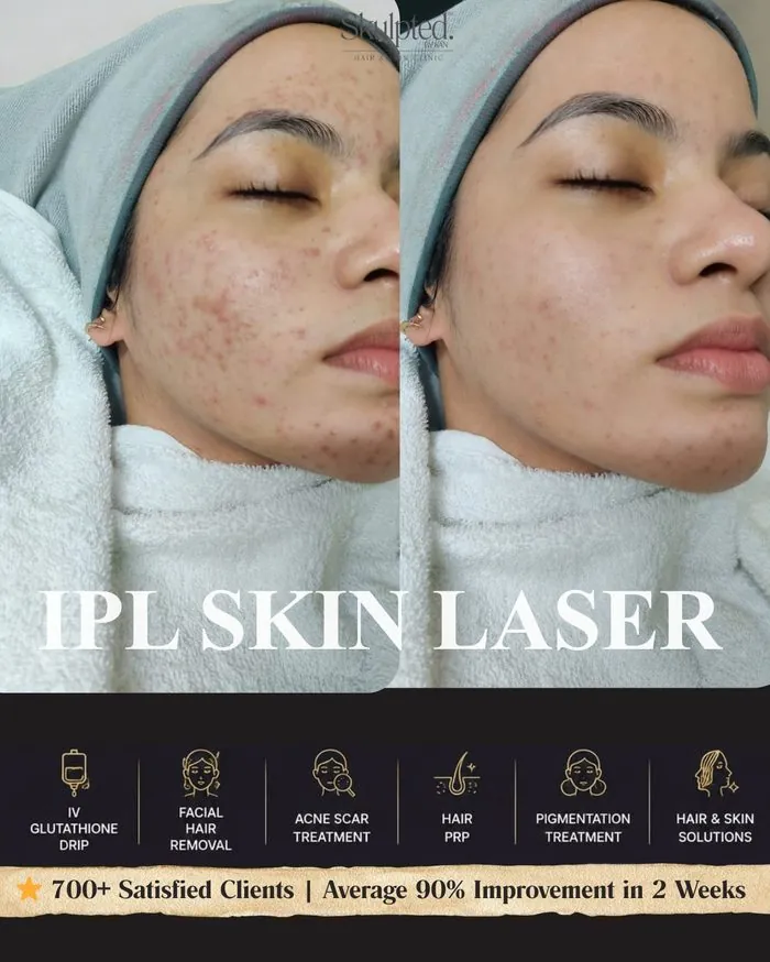 IPL Skin Laser — Active Acne