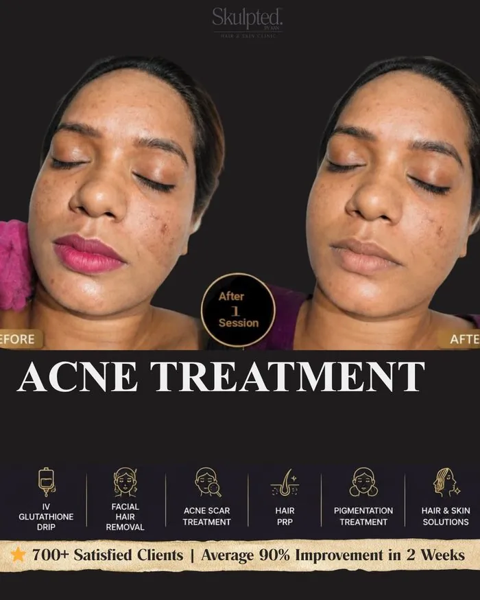 Acne Treatment — After 1 Session